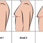 Njëri nga të plagosurit në Skenderaj në mjekim intensiv, i amputohet këmba